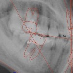 Odontoiatria: Come ho risolto la terza classe scheletrica o morso inverso con linea mediana across….la mia esperienza